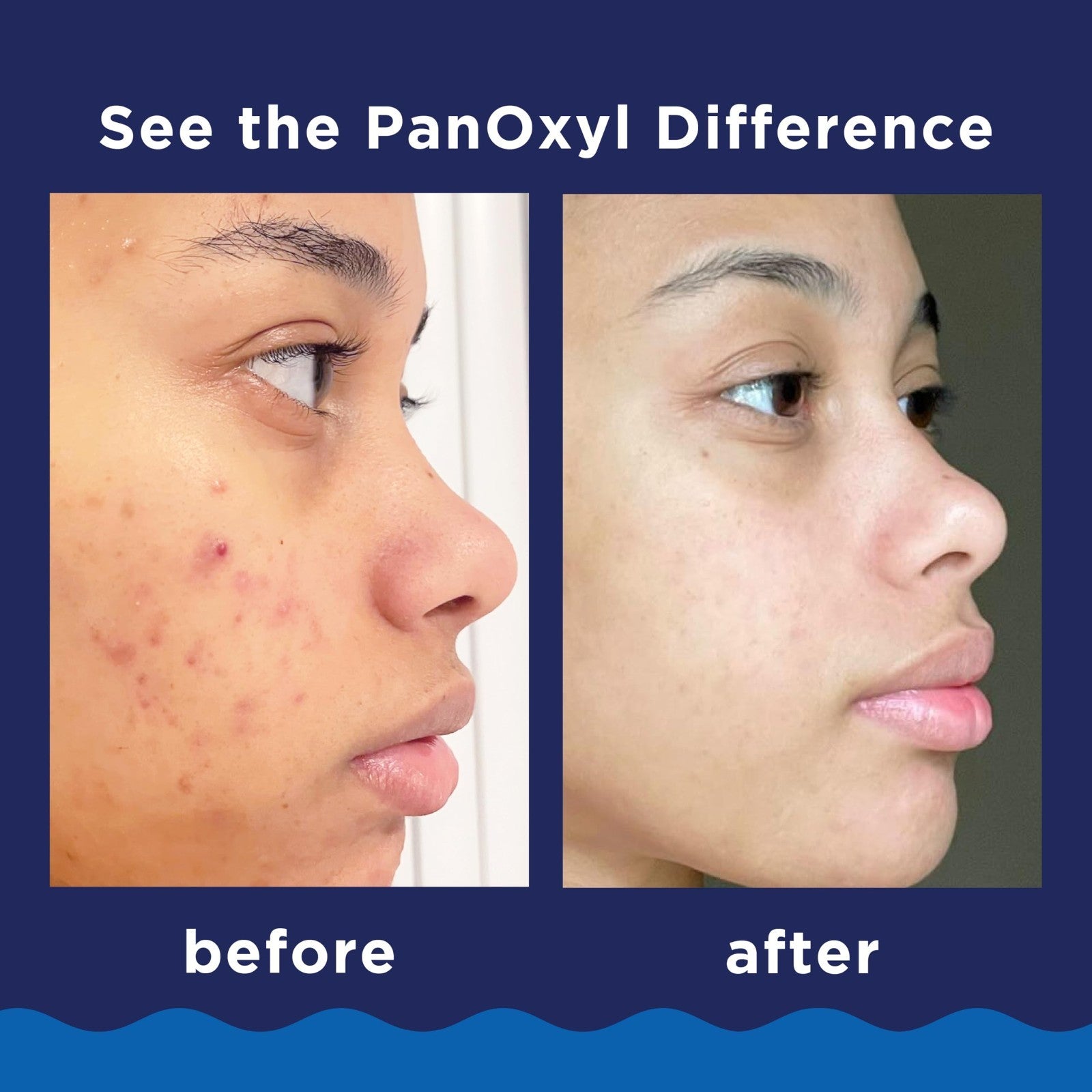 Acne Foaming Wash 10% Benzoyl Peroxide - 3 oz, Pack of 2 - Clear Skin Solution3