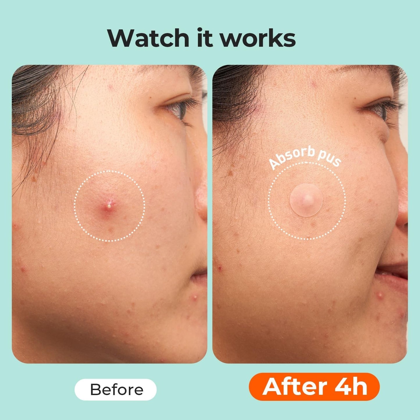 443 Count Hydrocolloid Pimple Patches for Face   Acne Treatment Cover Patch Bulk5