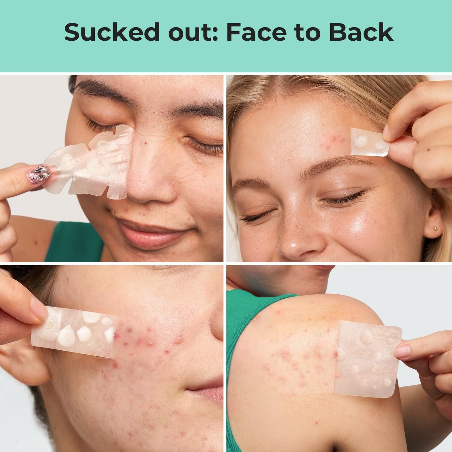 Large Hydrocolloid Pimple Patches for Acne Breakouts   4 Sizes, Fast Healing5