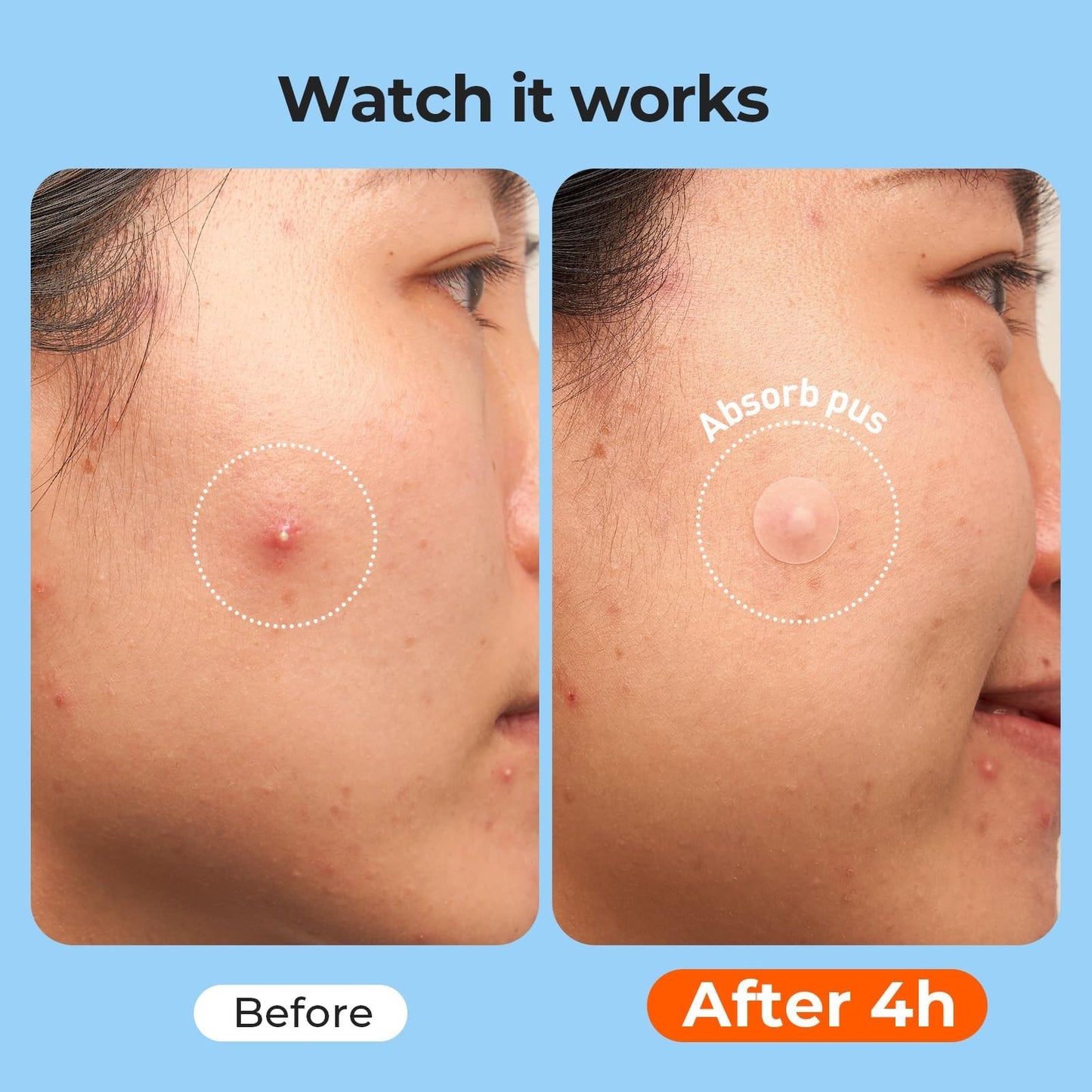 609 Count Hydrocolloid Pimple Patches for Face   Acne Treatment Cover Dots5
