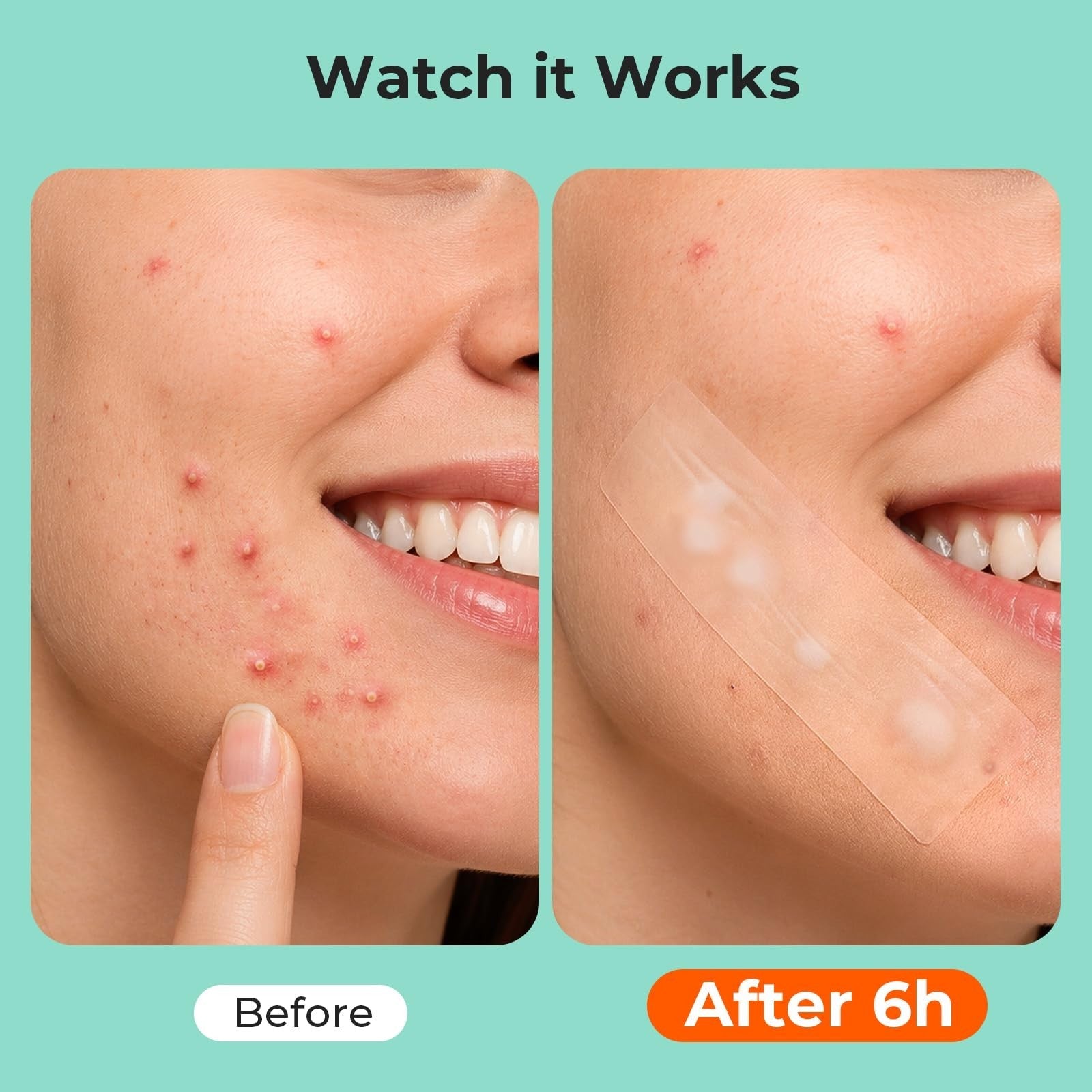 Large Hydrocolloid Pimple Patches for Acne Breakouts   4 Sizes, Fast Healing4
